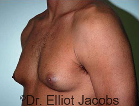 Male breast, before Gynecomastia treatment, l-side oblique view - patient 33