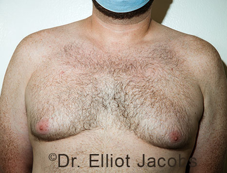 Male breast, before Gynecomastia treatment, front view, patient 112