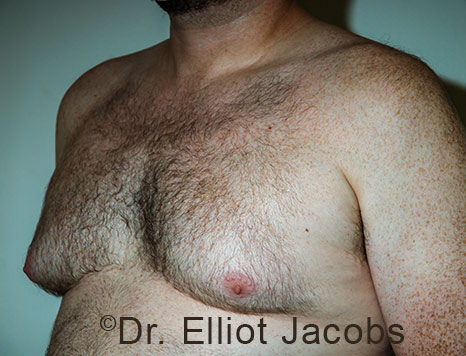 Male breast, before Gynecomastia treatment, l-side oblique view - patient 112