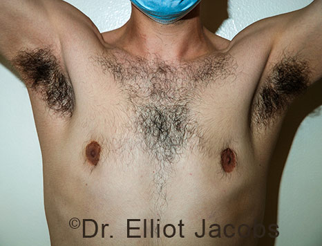 Men's breast, before Crater Deformity Repair treatment, front view - patient 8