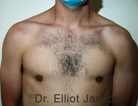 Men's breast, before Crater Deformity Repair treatment, front view, patient 8