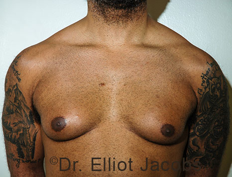 Male breast, before Gynecomastia treatment, front view, patient 113