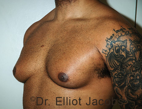 Male breast, before Gynecomastia treatment, l-side oblique view - patient 113