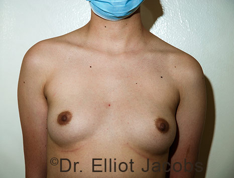Gynecomastia. Male breast, before FTM Top Surgery treatment, front view, patient 33