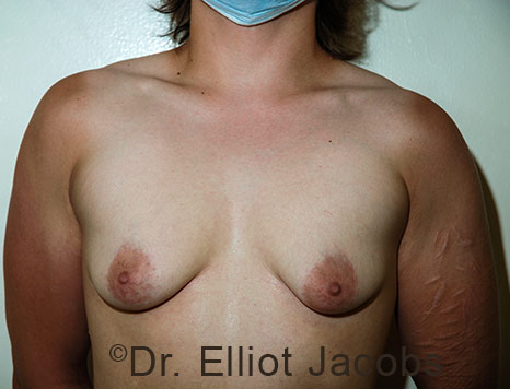 Gynecomastia. Male breast, before FTM Top Surgery treatment, front view, patient 34