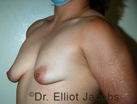 Gynecomastia. Male breast, before FTM Top Surgery treatment, l-side oblique view, patient 34