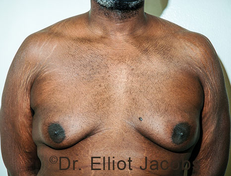 Male breast, before Gynecomastia treatment, front view, patient 114