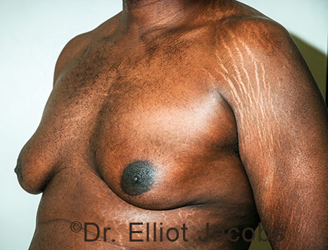 Male breast, before Gynecomastia treatment, l-side oblique view - patient 114