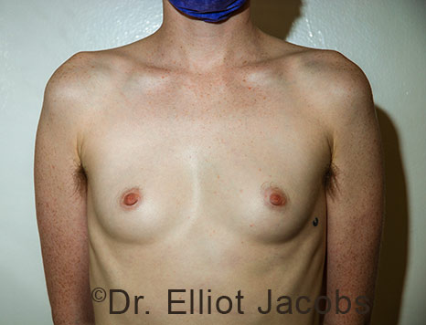 Gynecomastia. Male breast, before FTM Top Surgery treatment, front view, patient 35