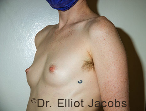 Gynecomastia. Male breast, before FTM Top Surgery treatment, l-side oblique view, patient 35