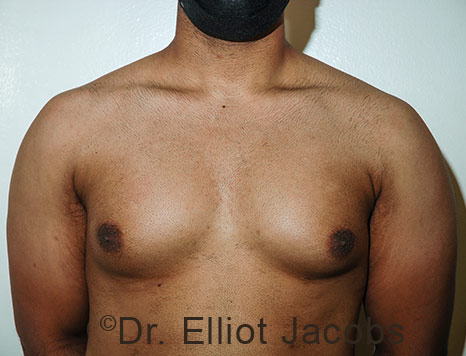 Male breast, before Gynecomastia treatment, front view, patient 115