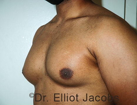 Male breast, before Gynecomastia treatment, l-side oblique view - patient 115