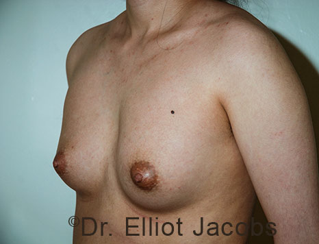 Gynecomastia. Male breast, before FTM Top Surgery treatment, l-side oblique view, patient 36