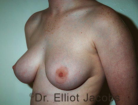 Gynecomastia. Male breast, before FTM Top Surgery treatment, l-side oblique view, patient 37