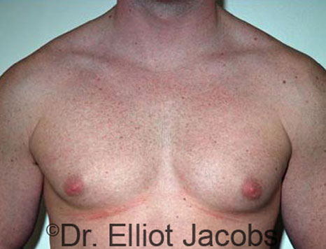 Male breast, before Gynecomastia treatment, front view, patient 34