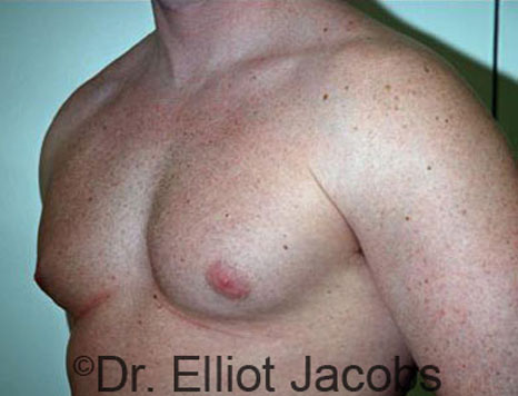 Male breast, before Gynecomastia treatment, l-side oblique view - patient 34