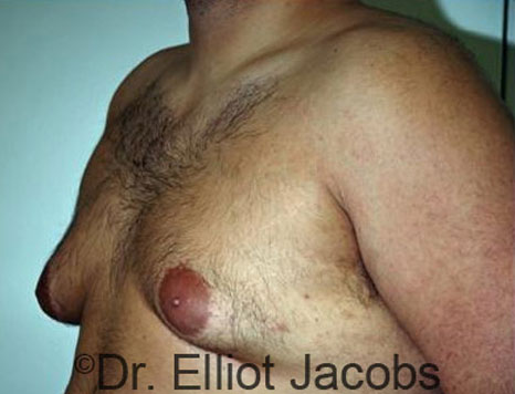 Male breast, before Gynecomastia treatment, l-side oblique view - patient 35