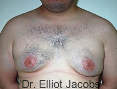 Male breast, before Gynecomastia treatment, front view, patient 36