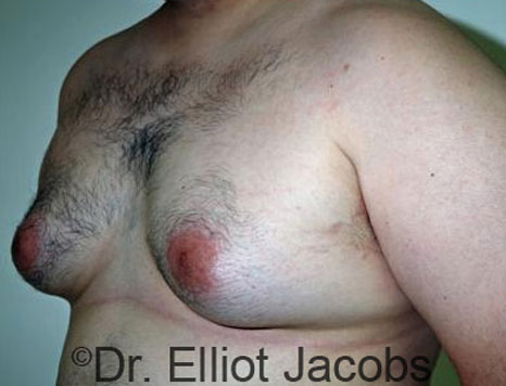 Male breast, before Gynecomastia treatment, l-side oblique view - patient 36