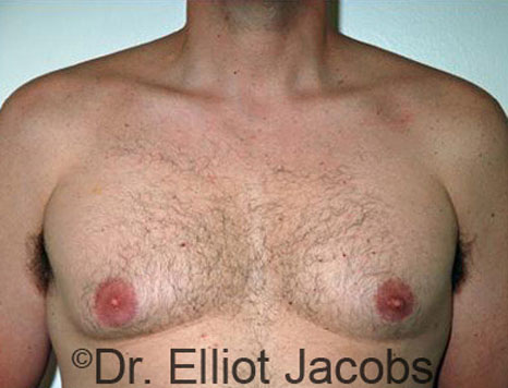 Male breast, before Gynecomastia treatment, front view, patient 37