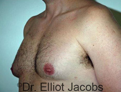 Male breast, before Gynecomastia treatment, l-side oblique view - patient 37