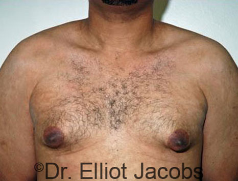 Male breast, before Gynecomastia treatment, front view, patient 38