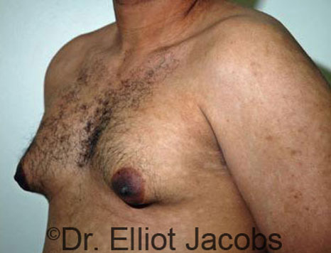 Male breast, before Gynecomastia treatment, l-side oblique view - patient 38