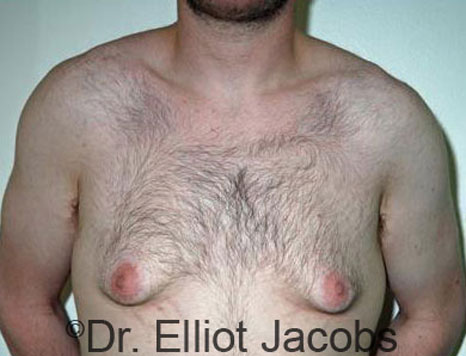 Male breast, before Gynecomastia treatment, front view, patient 39