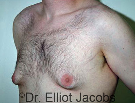 Male breast, before Gynecomastia treatment, l-side oblique view - patient 39