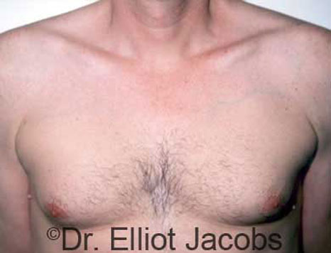 Male breast, before Gynecomastia treatment, front view, patient 4