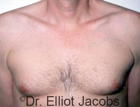 Treatment Male Chest Asymmetry | Boca Raton