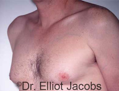Male breast, before Gynecomastia treatment, l-side oblique view, patient 4
