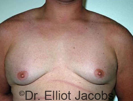 Male breast, before Gynecomastia treatment, front view, patient 40