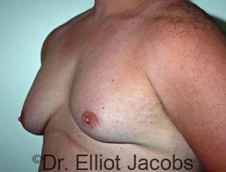 Male breast, before Gynecomastia treatment, l-side oblique view - patient 40