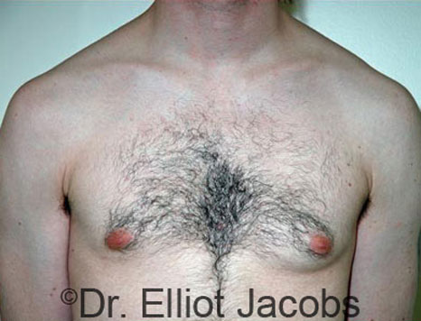 Male breast, before Gynecomastia treatment, front view, patient 41