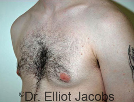Male breast, before Gynecomastia treatment, l-side oblique view - patient 41