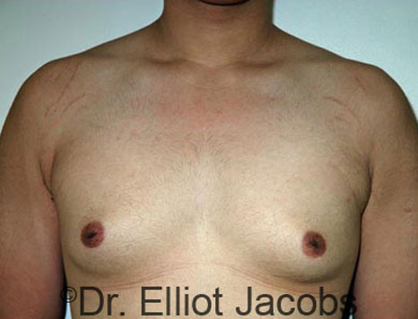 Male breast, before Gynecomastia treatment, front view, patient 42