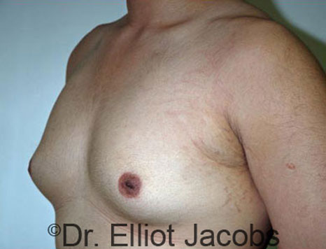 Male breast, before Gynecomastia treatment, l-side oblique view - patient 42