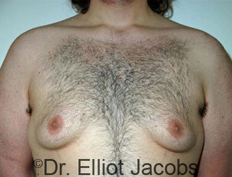 Male breast, before Gynecomastia treatment, front view, patient 43