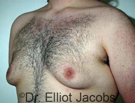Male breast, before Gynecomastia treatment, l-side oblique view - patient 43