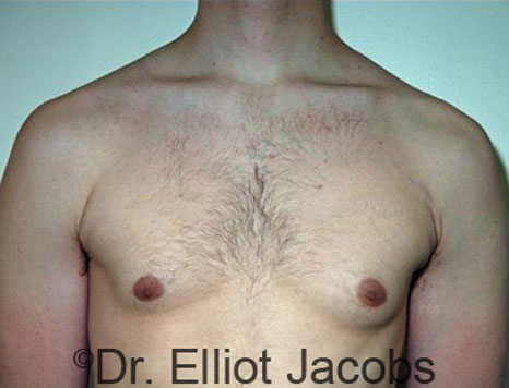 Male breast, before Gynecomastia treatment, front view, patient 44