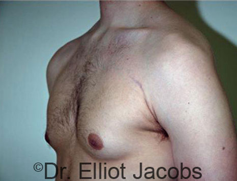 Male breast, before Gynecomastia treatment, l-side oblique view - patient 44
