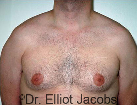 Male breast, before Gynecomastia treatment, front view, patient 45
