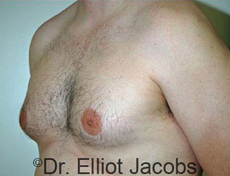 Male breast, before Gynecomastia treatment, l-side oblique view - patient 45