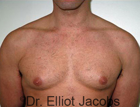Male breast, before Gynecomastia treatment, front view, patient 46