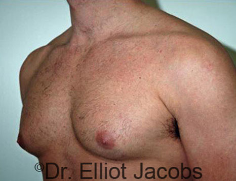 Male breast, before Gynecomastia treatment, l-side oblique view - patient 46
