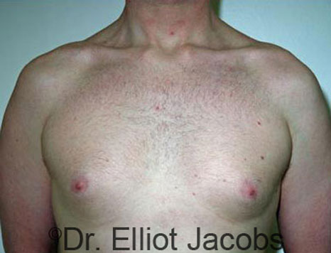 Male breast, before Gynecomastia treatment, front view, patient 47