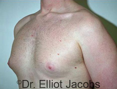 Male breast, before Gynecomastia treatment, l-side oblique view - patient 47