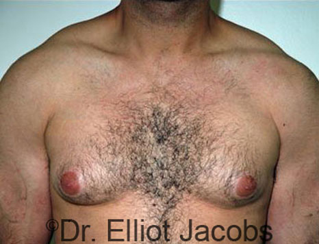 Male breast, before Gynecomastia treatment, front view, patient 48
