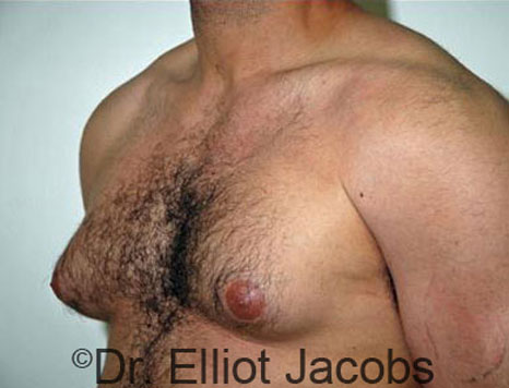 Male breast, before Gynecomastia treatment, l-side oblique view - patient 48